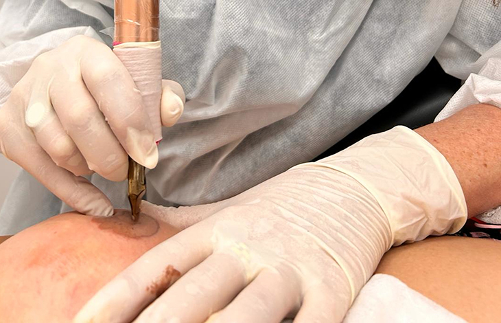 L’hospital de Palamós implementa la micropigmentació del mugró a dones que han patit càncer de mama